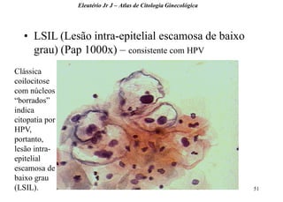 51 
•LSIL (Lesão intra-epitelial escamosa de baixo grau) (Pap 1000x) – consistente com HPV 
Eleutério Jr J – Atlas de Citologia Ginecológica 
Clássica coilocitose com núcleos “borrados” indica citopatia por HPV, portanto, lesão intra- epitelial escamosa de baixo grau (LSIL).  
