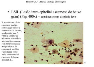 52 
•LSIL (Lesão intra-epitelial escamosa de baixo grau) (Pap 400x) – consistente com displasia leve 
Eleutério Jr J – Atlas de Citologia Ginecológica 
A presença de célula escamosa madura atípica cujo núcleo é aumentado de volume, sendo maior que 3 vezes o volume do núcleo de uma célula intermediária normal, com hipercromasia e irregularidade de contorno é também classificada como lesão intra-epitelial escamosa de baixo grau (LSIL).  