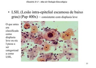53 
•LSIL (Lesão intra-epitelial escamosa de baixo grau) (Pap 400x) – consistente com displasia leve 
Eleutério Jr J – Atlas de Citologia Ginecológica 
O que antes era classificada como displasia leve ou nic I passa a ser categorizada como LSIL.  