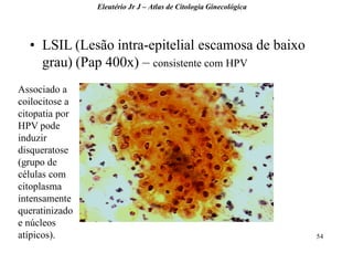 54 
•LSIL (Lesão intra-epitelial escamosa de baixo grau) (Pap 400x) – consistente com HPV 
Eleutério Jr J – Atlas de Citologia Ginecológica 
Associado a coilocitose a citopatia por HPV pode induzir disqueratose (grupo de células com citoplasma intensamente queratinizado e núcleos atípicos).  