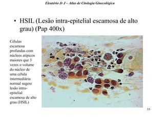 55 
•HSIL (Lesão intra-epitelial escamosa de alto grau) (Pap 400x) 
Eleutério Jr J – Atlas de Citologia Ginecológica 
Células escamosa profundas com núcleos atípicos maiores que 3 vezes o volume do núcleo de uma célula intermediária normal sugere lesão intra- epitelial escamosa de alto grau (HSIL)  