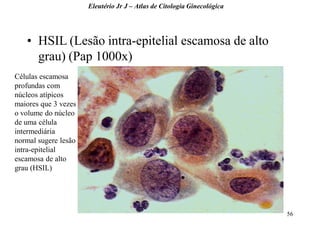 56 
•HSIL (Lesão intra-epitelial escamosa de alto grau) (Pap 1000x) 
Eleutério Jr J – Atlas de Citologia Ginecológica 
Células escamosa profundas com núcleos atípicos maiores que 3 vezes o volume do núcleo de uma célula intermediária normal sugere lesão intra-epitelial escamosa de alto grau (HSIL)  