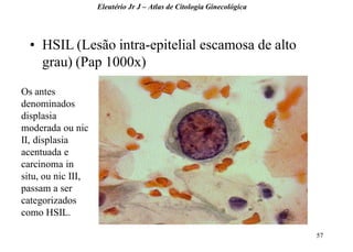 57 
•HSIL (Lesão intra-epitelial escamosa de alto grau) (Pap 1000x) 
Eleutério Jr J – Atlas de Citologia Ginecológica 
Os antes denominados displasia moderada ou nic II, displasia acentuada e carcinoma in situ, ou nic III, passam a ser categorizados como HSIL.  
