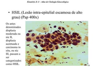 58 
•HSIL (Lesão intra-epitelial escamosa de alto grau) (Pap 400x) 
Eleutério Jr J – Atlas de Citologia Ginecológica 
Os antes denominados displasia moderada ou nic II, displasia acentuada e carcinoma in situ, ou nic III, passam a ser categorizados como HSIL.  