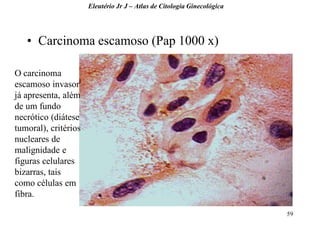 59 
•Carcinoma escamoso (Pap 1000 x) 
Eleutério Jr J – Atlas de Citologia Ginecológica 
O carcinoma escamoso invasor já apresenta, além de um fundo necrótico (diátese tumoral), critérios nucleares de malignidade e figuras celulares bizarras, tais como células em fibra.  