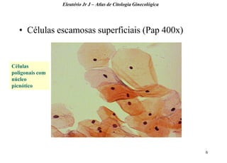 6 
•Células escamosas superficiais (Pap 400x) 
Eleutério Jr J – Atlas de Citologia Ginecológica 
Células poligonais com núcleo picnótico  