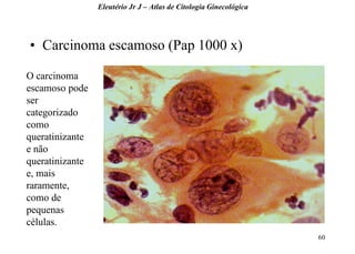 60 
•Carcinoma escamoso (Pap 1000 x) 
Eleutério Jr J – Atlas de Citologia Ginecológica 
O carcinoma escamoso pode ser categorizado como queratinizante e não queratinizante e, mais raramente, como de pequenas células.  