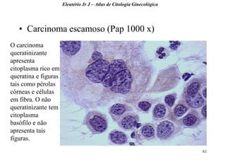 61 
•Carcinoma escamoso (Pap 1000 x) 
Eleutério Jr J – Atlas de Citologia Ginecológica 
O carcinoma queratinizante apresenta citoplasma rico em queratina e figuras tais como pérolas córneas e células em fibra. O não queratinizante tem citoplasma basófilo e não apresenta tais figuras.  