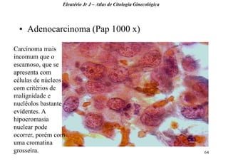 64 
•Adenocarcinoma (Pap 1000 x) 
Eleutério Jr J – Atlas de Citologia Ginecológica 
Carcinoma mais incomum que o escamoso, que se apresenta com células de núcleos com critérios de malignidade e nucléolos bastante evidentes. A hipocromasia nuclear pode ocorrer, porém com uma cromatina grosseira.  
