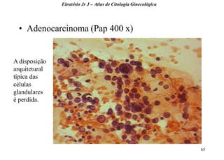 65 
•Adenocarcinoma (Pap 400 x) 
Eleutério Jr J – Atlas de Citologia Ginecológica 
A disposição arquitetural típica das células glandulares é perdida.  