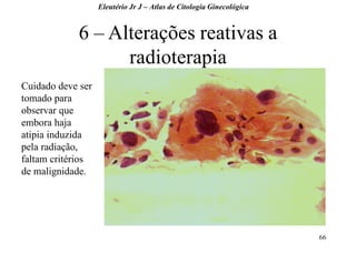 66 
6 – Alterações reativas a radioterapia 
Eleutério Jr J – Atlas de Citologia Ginecológica 
Cuidado deve ser tomado para observar que embora haja atipia induzida pela radiação, faltam critérios de malignidade.  