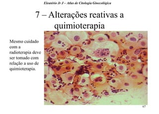 67 
Eleutério Jr J – Atlas de Citologia Ginecológica 
7 – Alterações reativas a quimioterapia 
Mesmo cuidado com a radioterapia deve ser tomado com relação a uso de quimioterapia.  