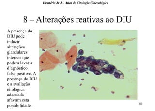 68 
Eleutério Jr J – Atlas de Citologia Ginecológica 
8 – Alterações reativas ao DIU 
A presença do DIU pode induzir alterações glandulares intensas que podem levar a diagnóstico falso positivo. A presença do DIU e a avaliação citológica adequada afastam esta possibilidade. 