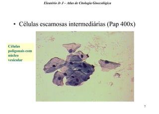 7 
•Células escamosas intermediárias (Pap 400x) 
Eleutério Jr J – Atlas de Citologia Ginecológica 
Células poligonais com núcleo vesicular  