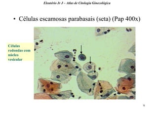 9 
•Células escamosas parabasais (seta) (Pap 400x) 
Eleutério Jr J – Atlas de Citologia Ginecológica 
Células redondas com núcleo vesicular  