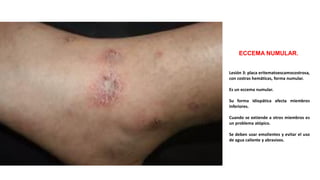 Forma Numular ATLAS DE DERMATOLOGÍA COMPLETO CON IMÁGENES | PDF