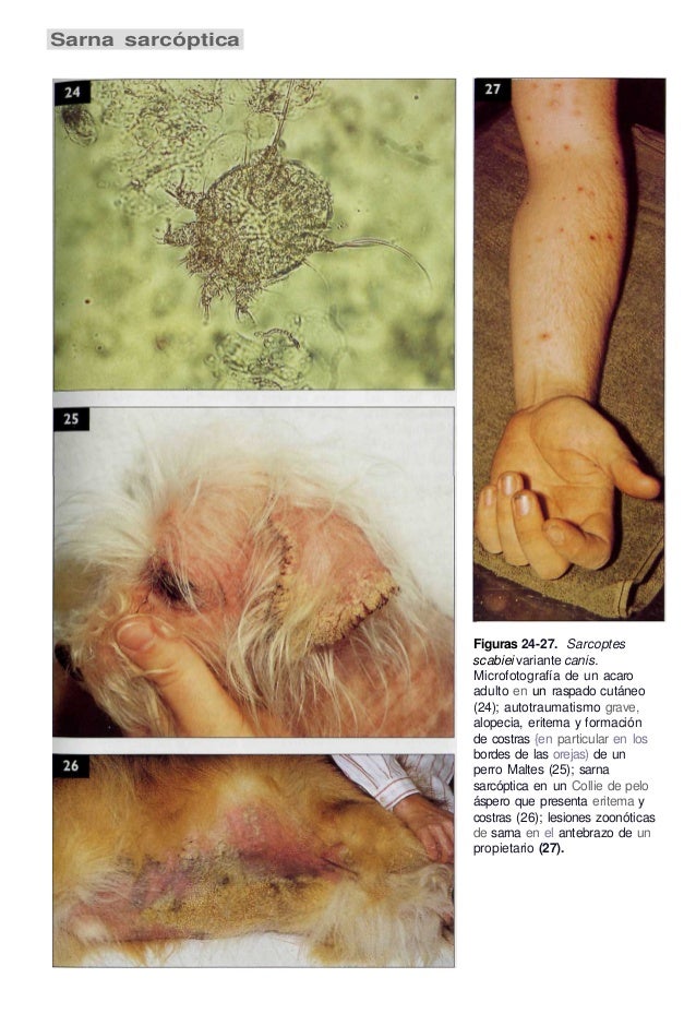 Caen los cabellos a la psoriasis. Que hacer