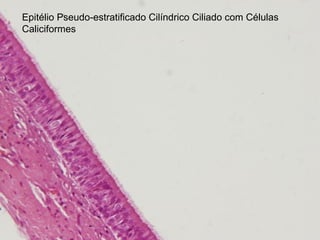 Epitélio Pseudo-estratificado Cilíndrico Ciliado com Células
Caliciformes
 