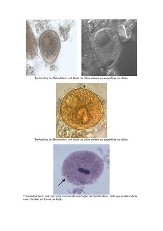 Trofozoítos de Balantidium coli. Note os cílios visíveis na superfície da célula.
Trofozoítos de Balantidium coli. Note os cílios visíveis na superfície da célula.
Trofozoítos de B. coli com uma mancha de coloração de hematoxilina. Note que a seta indica
macronúcleo em forma de feijão.
 