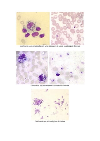 Leishmania spp. amastigotas em uma raspagem do tecido corados pelo Giemsa.
Leishmania spp. Amastigotas coradas com Giemsa.
Leishmania sp. promastigotas de cultura
 