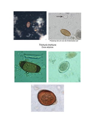 Presença de um ovo de Entamoeba coli
Trichuris trichiura
Ovos atípicos
 