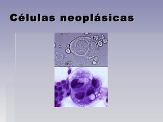 Células neoplásicasCélulas neoplásicas
 