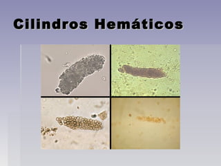 Cilindros HemáticosCilindros Hemáticos
 