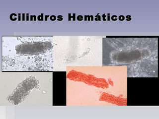 Cilindros HemáticosCilindros Hemáticos
 