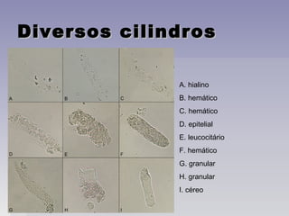 Diversos cilindrosDiversos cilindros
A. hialino
B. hemático
C. hemático
D. epitelial
E. leucocitário
F. hemático
G. granular
H. granular
I. céreo
 