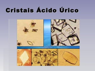 Cristais Ácido ÚricoCristais Ácido Úrico
 