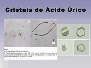 Cristais de Ácido ÚricoCristais de Ácido Úrico
 