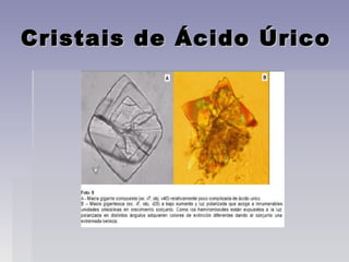 Cristais de Ácido ÚricoCristais de Ácido Úrico
 