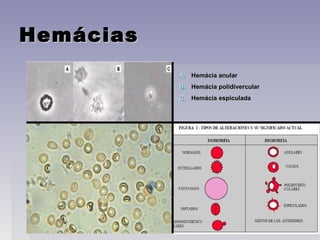 HemáciasHemácias
A.A. Hemácia anularHemácia anular
B.B. Hemácia polidivercularHemácia polidivercular
C.C. Hemácia espiculadaHemácia espiculada
 