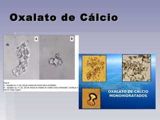 Oxalato de CálcioOxalato de Cálcio
 