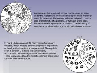A represents the residue of normal human urine, as seen
under the microscope. In division B is represented oxalate of
urea. An excess of this element indicates indigestion, and is
also characteristic of a plethoric, or full habit of the body.
Nitrate of urea is represented in division C. A deficiency of
urea in the renal secretion is a certain indication of anæmia.
In Fig. 2 (divisions A and B), highly magnified urinary
deposits, which indicate different degrees of impairment
of the digestive functions are represented. The crystals
seen in division C indicate the same debility
accompanied with derangement of the mental faculties.
Those in divisions D and E indicate still more aggravated
forms of the same disorder.
 