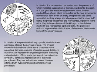 In division A is represented pus and mucus, the presence of
which indicates suppuration of the kidneys (Bright's disease).
In B pus globules are alone represented. In the division
marked C are shown blood corpuscles as they are arranged in
blood drawn from a vein or artery. D represents the same
separated, as they always are when present in the urine. In E
highly magnified oil globules are represented. If present in the
urine, they indicate disease of the kidneys. In the division
marked F are represented epithelial cells, the presnce of
which in large numbers is indicative of diseaes of the mucous
lining of the urinary organs.
In division A are presented urinary crystals, which indicate
an irritable state of the nervous system. The crystals
shown in division B are of the same character as the
preceding, but bear evidence of greater mental debility. In
division C are represented crystalling deposits indicating
malassimilation of food and a tendency to hypochondria.
Division D contains a representation of the mixed
phosphates. They are indicative of severe diseases
attended with hypochondria and general nervous
prostration.
 