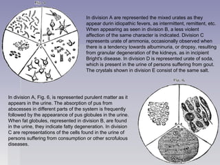 In division A are represented the mixed urates as they
appear durin idiopathic fevers, as intermittent, remittent, etc.
When appearing as seen in division B, a less violent
affection of the same character is indicated. Division C
represents urate of ammonia, occasionally observed when
there is a tendency towards albuminuria, or dropsy, resulting
from granular degeneration of the kidneys, as in incipient
Bright's disease. In division D is represented urate of soda,
which is present in the urine of persons suffering from gout.
The crystals shown in division E consist of the same salt.
In division A, Fig. 6, is represented purulent matter as it
appears in the urine. The absorption of pus from
abscesses in different parts of the system is frequently
followed by the appearance of pus globules in the urine.
When fat globules, represented in division B, are found
in the urine, they indicate fatty degeneration. In division
C are representations of the cells found in the urine of
persons suffering from consumption or other scrofulous
diseases.
 