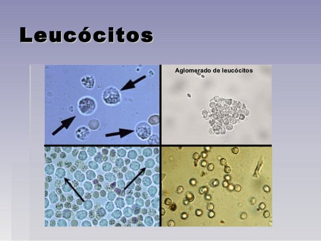 LEUCOCITOS BAIXOS NA URINA