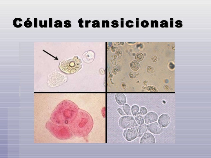 Celulas epiteliais numerosas no exame de urina