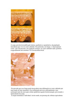A caspa, provém da modificação intensa, qualitativa e quantitativa, da população
microbiana que vive no couro cabeludo. Em particular, um fungo, o "pityrosporum
ovale", que está presente, em condições normais, no couro cabeludo sadio, prolifera
exageradamente até constituir 75% da microflora local.
Foi provado que esse fungo pode desencadear uma inflamação no couro cabeludo por
uma reação do tipo imunitário. Essa inflamação provoca, principalmente, uma
aceleração tanto da renovação celular epidérmica quanto da descamação, provocando o
aparecimento da caspa.
A reação imunitária é individual. Assim sendo, em presença de colônias equivalentes
 