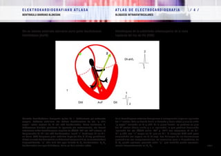 E L E K T R O K A R D I O G R A F I A K O AT L A S A 			 AT L A S D E E L E C T R O C A R D I O G R A F í A / 4 /
BENTRIKULU BARRUKO BLOKEOAK BLOQUEOS INTRAVENTRICULARES
/ 98 /
His-en balaren ezkerreko adarraren aurre-goiko faszikuluaren
hemiblokeoa (AuHB)
Hemibloqueo de la subdivisión anterosuperior de la rama
izquierda del haz de His (HBA)
Aurreko hemiblokeoan desagertu egiten da 1. bektorearen goi-ezkerreko
osagaia, bektorea eskuinera eta behera desbideratzen da eta “q uhin
septal” estua sortzen du DI eta aVL deribazioetan. Plano frontalean, 2.
bektorearen biraketa gertatzen da (gorantz eta ezkerrerantz), eta horrek
ardatzaren ezker-desbiderapena eragiten du (ÂQRS -45º eta -75º artean), rS
konplexuekin DII-DIII eta aVF deribazioetan, izanik “r” handiagoa DII-an DIII-
an baino. QRS konplexua gutxi zabaldua dago (ez ditu 0,10 seg gainditzen).
Bihotz aurreko deribazioetako aurkikuntzak osagarriak dira, ez ezinbestekoak
diagnostikorako: “q” uhin txiki bat ager daiteke V1
-V2
deribazioetan, V5
-V6
deribazioetan ere ager daitekeena, baina ez hain sarritan ordea.
En el hemibloqueo anterior desaparece el componente superior izquierdo
del 1º vector, éste se desvía hacia la derecha y hacia abajo y origina onda
“q septal” estrecha en DI y aVL. En el plano frontal, se produce un giro
del 2º vector (hacia arriba y a la Izquierda), lo que produce desviación
izquierda del eje (ÂQRS entre -45º y -75º) con complejos rS en DII-
DIII y aVF, con “r” mayor en DII que en DIII. El complejo QRS está poco
ensanchado (no supera los 0,10 seg). Los hallazgos de las derivaciones
precordiales son complementarios, no esenciales para el diagnóstico: en
V1
-V2
puede aparecer pequeña onda “q”, que también puede aparecer,
menos frecuentemente en V5
-V6
.
 