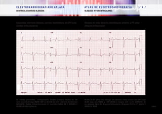 E L E K T R O K A R D I O G R A F I A K O AT L A S A 			 AT L A S D E E L E C T R O C A R D I O G R A F í A / 4 /
BENTRIKULU BARRUKO BLOKEOAK BLOQUEOS INTRAVENTRICULARES
/ 106 /
Eskuineko adarraren blokeoa, aurreko hemiblokeoa eta PR luzea
(blokeo trifaszikularra)
Bloqueo de rama derecha, hemibloqueo anterior y PR largo
(bloqueo trifascicular)
81 urteko gizonezkoa,   sinkopearekin. Erritmo sinusala ikusten da, PR
uhin luzea (0,37 seg), ÂQRS -80º-ra (AuHB) eta rsR´ irudia V1
deribazioan
(HBEsAB). Blokeo trifaszikularraren (1. mailako blokeo AB + HBEsAB +
AuHB) adibide tipikoa da.
Varón de 81 años con síncope. Se observa ritmo sinusal con PR largo
(0,37 seg), con ÂQRS a –80º (HBA) e imagen rsR´ en V1
(BRDHH). Es
un ejemplo típico de bloqueo trifascicular (bloqueo A-V de 1º grado +
BRDHH + HBA)
 