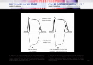 E L E K T R O K A R D I O G R A F I A K O AT L A S A 			 AT L A S D E E L E C T R O C A R D I O G R A F í A / 5 /
KARDIOPATIA ISKEMIKOA CARDIOPATÍA ISQUÉMICA
/ 108 /
A- EKG normal bat lortzea, subendokardioko eta subepikardioko mintzean
zeharreko ekintza-potentzialen (MzEPen) indarrak ezeztatzeagatik.
Iskemia subendokardikoan (B), berriz, subendokardioko MzEParen
iraupena luzatzen da, bere anplitudea aldatu gabe, eta horrek boltaje
handiagoko T uhin simetriko bat eragigo du
A- Obtención del ECG normal por cancelación de fuerzas de los potenciales
de acción transmembrana (PAT) del subendocardio y subepicardio. En
la isquemia subendocárdica (B) se prolonga la duración del PAT del
subendocardio, sin variar su amplitud, originando una onda T de mayor
voltaje y simétrica
SUBENDOKARDIOKO ISKEMIA
ISQUEMIA SUBENDOCÁRDICA
EKG NORMALA
ECG NORMAL
Subepikardioa
Subepicardio
Subendokardioa
Subendocardio
 