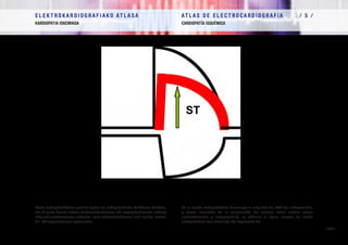 E L E K T R O K A R D I O G R A F I A K O AT L A S A 			 AT L A S D E E L E C T R O C A R D I O G R A F í A / 5 /
KARDIOPATIA ISKEMIKOA CARDIOPATÍA ISQUÉMICA
/ 120 /
Lesio subepikardikoan gutxitu egiten da subepikardioko MzEParen boltajea,
eta bi gune horien artean (subendokardioaren eta subepikardioaren artean)
indarrak ezeztatzearen ondorioz, lesio subepikardikoaren irudi tipikoa lortzen
da, ST segmentuaren igoerarekin
En la lesión subepicárdica disminuye la amplitud del PAT del subepicardio,
y como resultado de la cancelación de fuerzas entre ambas zonas
(subendocardio y subepicardio), se obtiene la típica imagen de lesión
subepicárdica con elevación del segmento ST
 