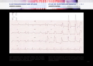 E L E K T R O K A R D I O G R A F I A K O AT L A S A 			 AT L A S D E E L E C T R O C A R D I O G R A F í A / 5 /
KARDIOPATIA ISKEMIKOA CARDIOPATÍA ISQUÉMICA
/ 132 /
Lesio subepikardiko larria, aurre-alboan kokatua, altua eta baxua,
uhin monofasikoarekin V1
deribazioan, eta horrek erasan koronario
esanguratsuaren susmoa ematen digu, aurreko beheranzko arteria
koronarioaren buxadura larri eta proximalarekin.
Severa lesión subepicárdica de localización anterior y lateral, alta y
baja, con onda monofásica desde V1
, lo que hace sospechar afectación
coronaria significativa, con obstrucción severa y proximal de la arteria
descendente anterior
 