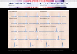 E L E K T R O K A R D I O G R A F I A K O AT L A S A 			 AT L A S D E E L E C T R O C A R D I O G R A F í A / 6 /
BRADIARRITMIAK BRADIARRITMIAS
/ 151 /Blokeo sino-aurikularra. Blokeo-tipo diferenteen eskema. Esquema de los diferentes tipos de bloqueo sino-auricular.
Erritmo sinusal normala
Lehen mailako blokeo SA
2. mailako blokeo SA, 1 tipokoa (Wenckebach SA)
2. mailako blokeo SA, 2 tipokoa
3. mailako blokeo SA, ihes nodularrarekin
Ritmo sinusal normal
Bloqueo SA de primer grado
Bloqueo SA de 2º grado tipo 1 (Wenckebach SA)
Bloqueo SA de 2º grado tipo 2
Bloqueo SA de 3º grado con escape nodal
 