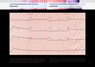 E L E K T R O K A R D I O G R A F I A K O AT L A S A 			 AT L A S D E E L E C T R O C A R D I O G R A F í A / 6 /
BRADIARRITMIAK BRADIARRITMIAS
/ 176 /
Flutter aurikularra bentrikuluaren erantzun motelarekin, blokeo AB
dela medio. QRS konplexuak EsABaren eta AuHBaren irudia ematen du, eta
horregatik blokeo baxua izan zitekeen. Sei F uhin bakoitzeko bakar batek soilik
eroaten du (aurreratzen den QRS konplexuren bat edo beste izan ezik).
Flutter auricular con respuesta ventricular lenta por bloqueo AV.
El QRS presenta imagen de BRD y HBA, por lo que podría ser por un
bloqueo bajo. Sólo una de cada 6 ondas F conduce (salvo algún QRS
que se anticipa).
 