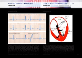 E L E K T R O K A R D I O G R A F I A K O AT L A S A 			 AT L A S D E E L E C T R O C A R D I O G R A F í A / 7 /
TAKIARRITMIAK TAQUIARRITMIAS
/ 180 /
Taupada aurreratuak dira. Aurikuletan sor daitezke, lotura ABean edo
bentrikuluetan. Aurikularren aurretik P uhina agertzen da (sinusala
ez bezalakoa, jatorria egitura horretatik urrun badago). Batzuetan P
uhina aurreko konplexuaren T uhinean sartua dago eta identifikatzen
zaila da. Taupadekin edo ihes-erritmoekin gertatzen den bezala lotura
ABeko estrasistoleek atzeranzko uhina QRS baino lehenago, konplexua
bitartean (horixe da arruntena) edo QRS ondoren izan dezakete. Era
berean, estrasistole bentrikularren morfologia diferentea izango da, zein
bentrikulutan sortzen diren kontu. Ikusi eskemak bradiarritmien atalean.
Son latidos anticipados. Pueden producirse en la aurícula, en la unión AV o
en los ventrículos. Los auriculares van precedidos de onda P (diferente a la
sinusal si el origen es lejano a esta estructura). A veces la P está metida en
la onda T del complejo anterior y es difícil de identificar. Al igual que ocurre
con los latidos o con los ritmos de escape los extrasístoles de la unión A-V
pueden presentar la onda retrógrada antes, durante (lo más frecuente) o
tras el QRS. Igualmente, la morfología de los extrasístoles ventriculares
dependerá del ventrículo en el que se originen. Ver esquemas en la sección
de bradiarritmias.
Estrasistole aurikularra (EA)
Loturako estrasistolea (LE)
Estrasistole bentrikularra (EB)
Extrasístole auricular (EA)
Extrasístole unional (EU)
Extrasístole ventricular (EV)
A/A
B/V
LE/EU
EA /
EA
EB /
EV
HIS / HIS
ESTRASISTOLEAK EXTRASÍSTOLES
 