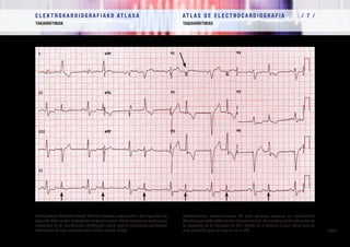 E L E K T R O K A R D I O G R A F I A K O AT L A S A 			 AT L A S D E E L E C T R O C A R D I O G R A F í A / 7 /
TAKIARRITMIAK TAQUIARRITMIAS
/ 185 /
Estrasistole bentrikularrak: Adibide honetan estrasistole bat agertzen da
(geziak) QRS normal bakoitzeko (bigeminismoa). Estrasistolearen morfologia
negatiboa da V1
deribazioan (EzABaren irudia, geziak markatua) eta horrek
adierazten du oso litekeena dela EsBan sortua izatea.
Extrasístoles ventriculares: En este ejemplo aparece un extrasístole
(flechas) por cada QRS normal (bigeminismo). La morfología del extrasístole
es negativa en V1
(imagen de BRI, flecha en la figura) lo que indica que es
muy probable que se origine en el VD.
 