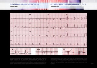 E L E K T R O K A R D I O G R A F I A K O AT L A S A 			 AT L A S D E E L E C T R O C A R D I O G R A F í A / 7 /
TAKIARRITMIAK TAQUIARRITMIAS
/ 192 /
Takikardia aurikularra: P uhina aurreko QRS-tik hurbil dago (ondo ikusten da
beheko aurpegian eta V1
deribazioan). Bentrikuluetarako eroapena 1/1 da.
P uhina positiboa denez V1
deribazioan eta negatiboa, aldiz, aVL-n, horrek jatorria
ezkerreko aurikulan dagoela iradokitzen du. P uhina beheko aurpegian positiboa
izateak, bestalde, jatorria aurikula horren goiko aldean dagoela iradokitzen du.
Taquicardia auricular: La onda P está cerca del QRS previo (se ve bien en
cara inferior y en V1
). La conducción a los ventrículos es 1/1. La positividad
de la P en V1
y la negatividad en aVL orientan hacia un origen auricular
izquierdo. La positividad en cara inferior hacia la parte superior de dicha
aurícula.
 